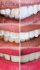 CeramiLux Ceramic like Clip in veneers