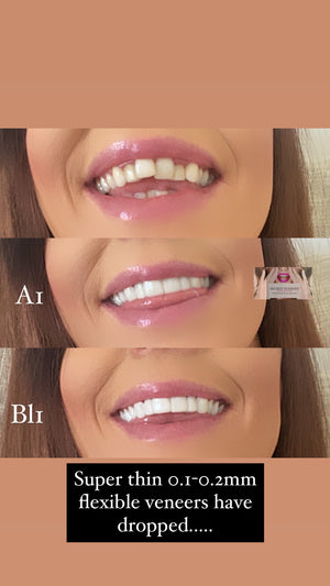 Premium super thin set of clip in veneers