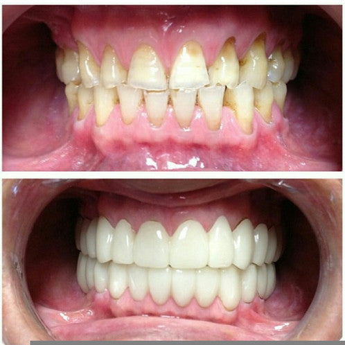 Standard clip in veneers for your upper AND lower teeth